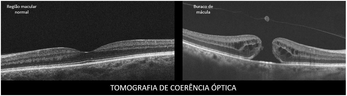 Cirurgia de Membrana Epirretiniana em Blumenau