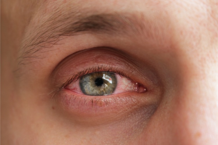 O que provoca inflamação nos olhos?