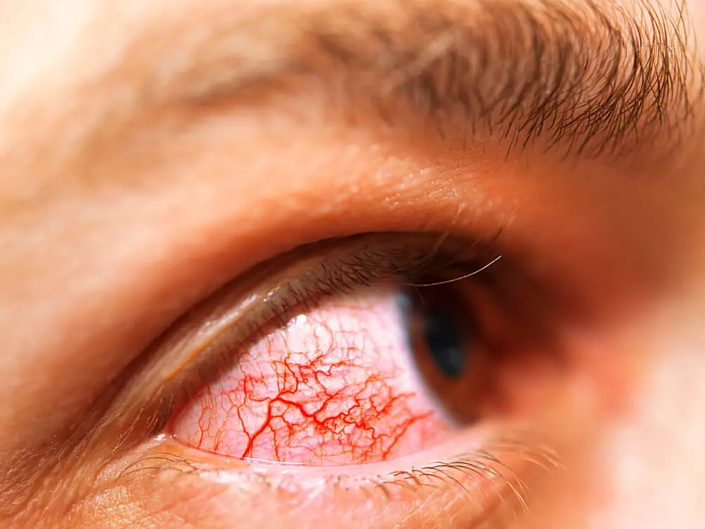 Ácaros podem provocar alergia nos olhos