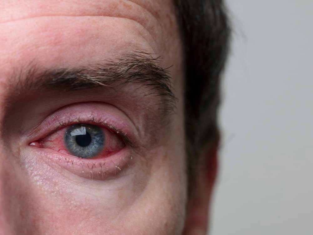 Produtos químicos podem causar alergia nos olhos