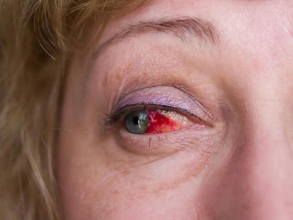 Existe tratamento para o Derrame Ocular?