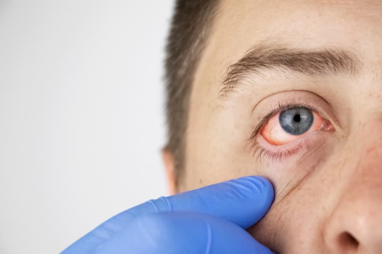 Onde encontrar tratamento pra alergia nos olhos?