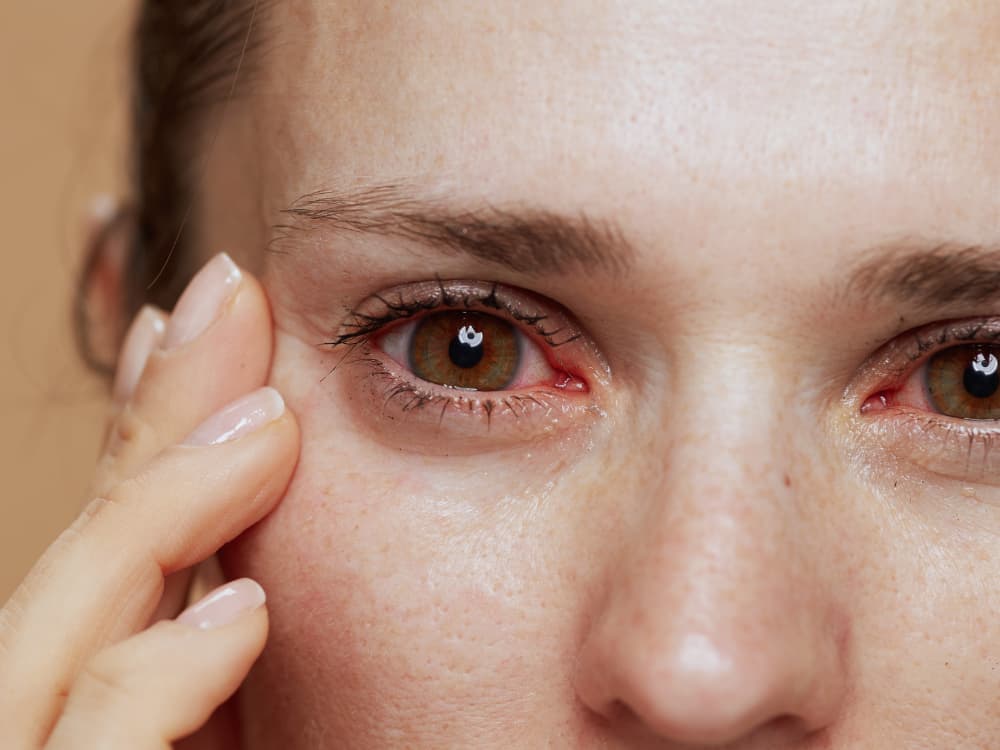 Quais são os principais tipos de alergia nos olhos?