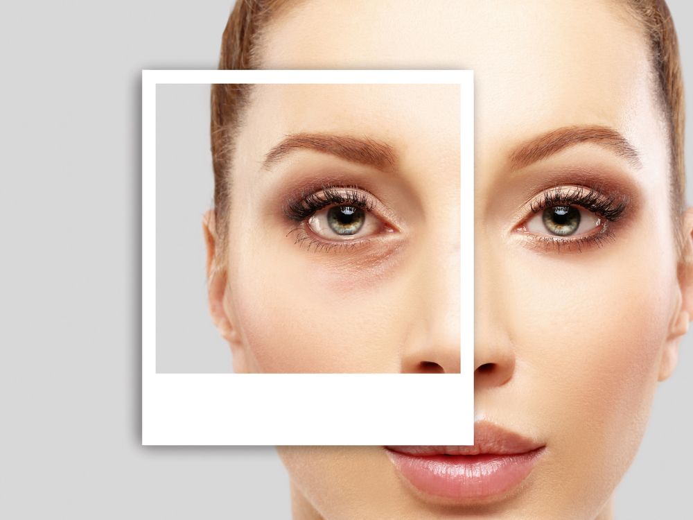 Como funciona a plástica nos olhos?