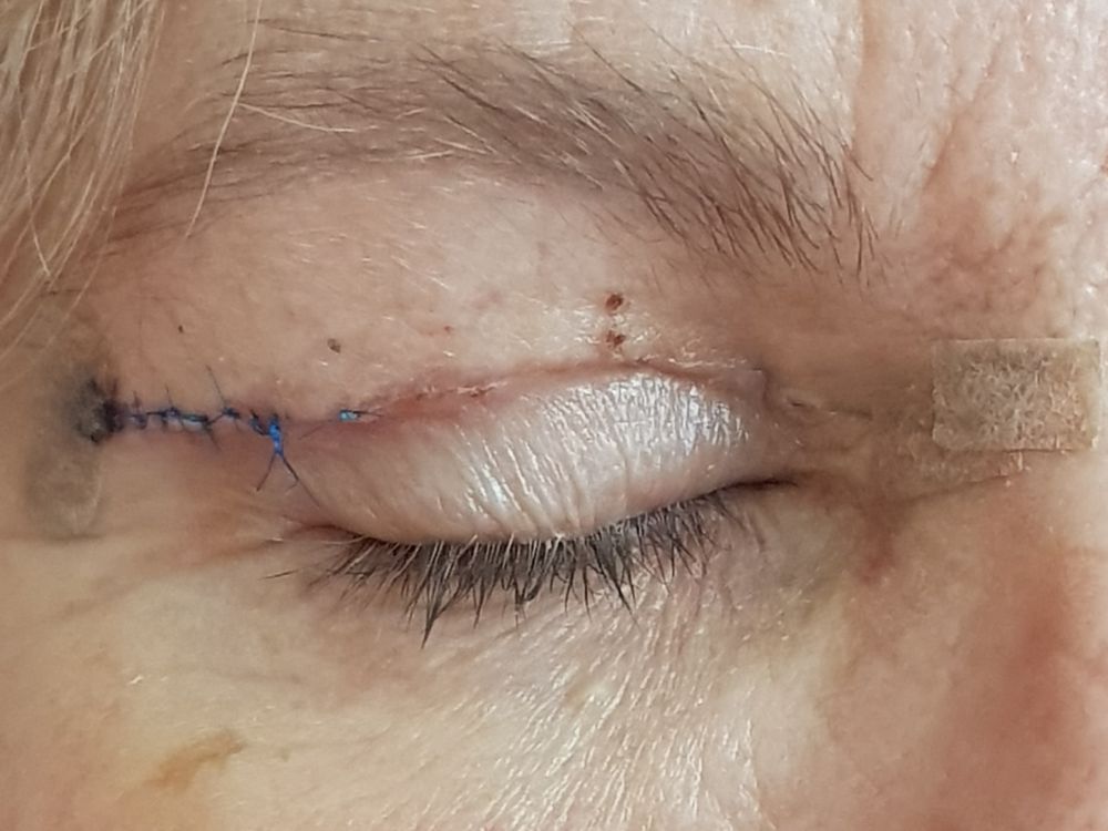 Onde fazer plástica nos olhos em Blumenau?