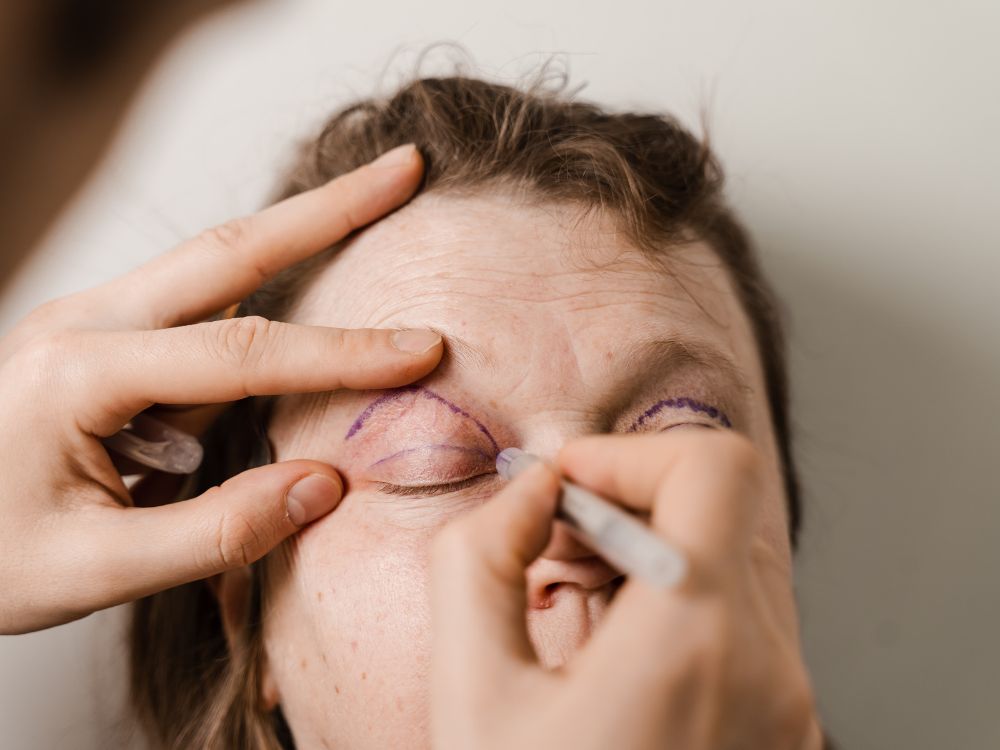Quais os benefícios da plástica nos olhos?