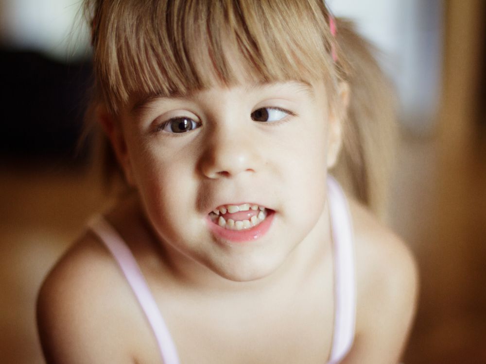 Menina com os olhos desalinhados, exemplificando a manifestação visual do estrabismo e incentivando o estudo sobre o que causa estrabismo.