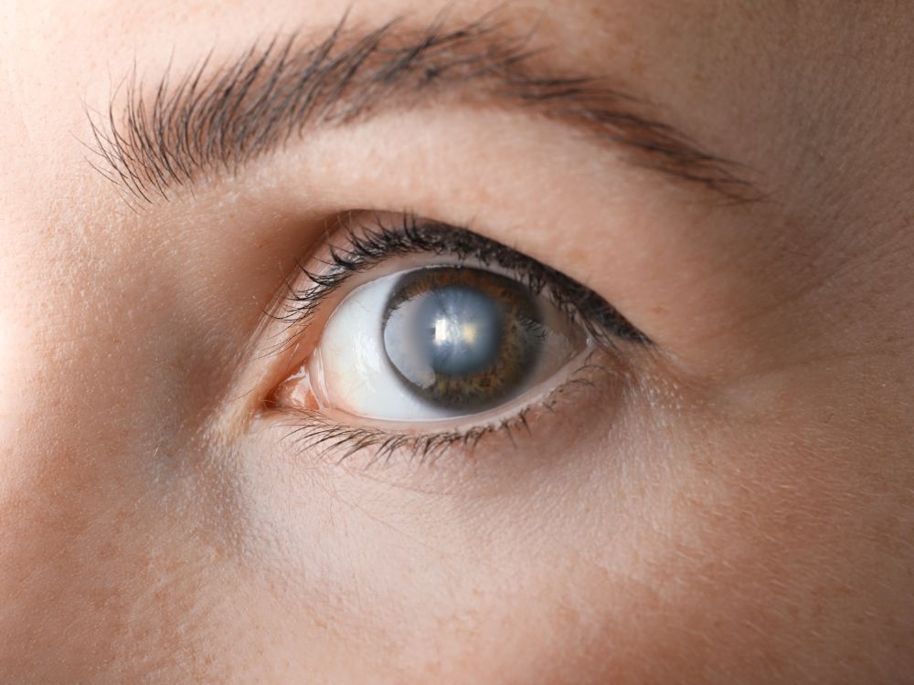 Detalhe do olho feminino com lente ocular opaca, indicando os primeiros sinais de catarata e sua progressão no cristalino.