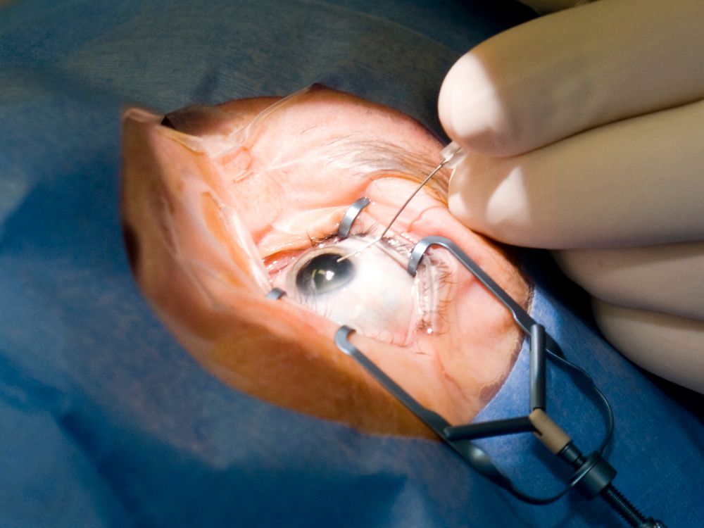 Procedimento cirúrgico ocular ilustrando possíveis causas de bolha no olho após cirurgia de catarata.