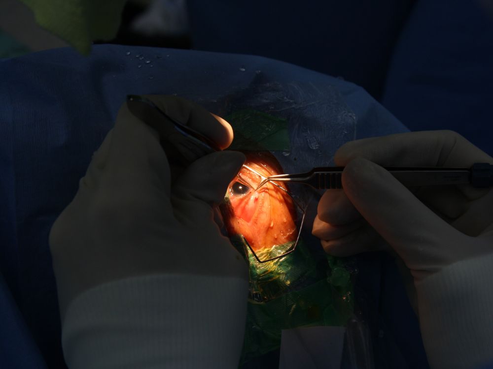 Cirurgia de catarata em andamento, onde podem surgir complicações como bolha no olho após cirurgia de catarata.