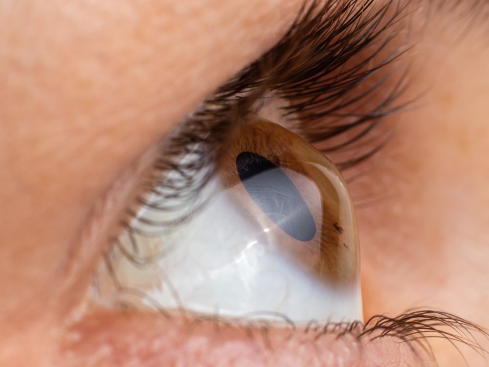 Imagem clínica do olho com ceratocone avançado, condição que muitas vezes é hereditária.