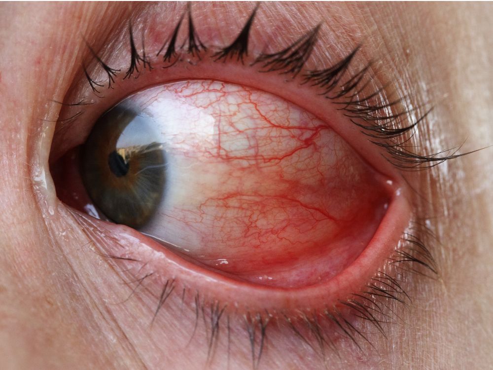 Olho com vasos dilatados e sinais de inflamação, ilustrando condição ocular grave ligada à córnea do olho danificada.